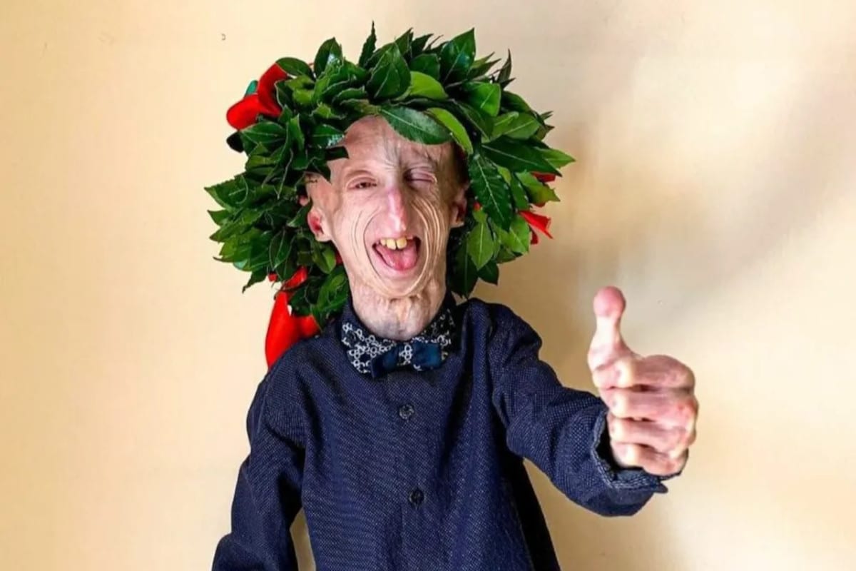 Sammy Basso progeria, cos’è e quanto può vivere? Malattia, fidanzata, laurea, genitori