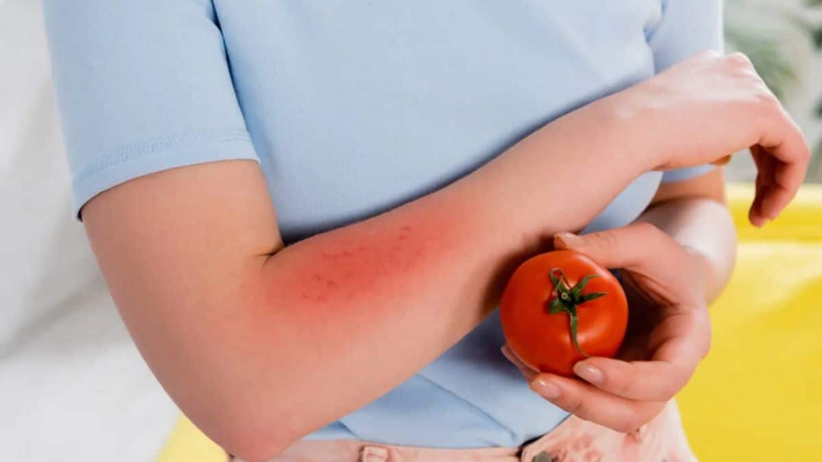 Influenza del pomodoro, il nuovo virus che colpisce i bambini: cos’è e quali sono i sintomi