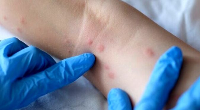 Primo caso pediatrico di vaiolo delle scimmie in Germania, contagiata una bambina di 4 anni